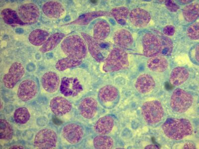 FNA lymphonode - lymphoma