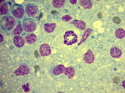 FNA lymphonode - mitotic figure